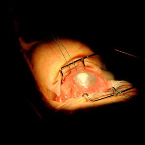Cornea transzplantáció 