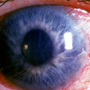 Boala de ochi glaucom
