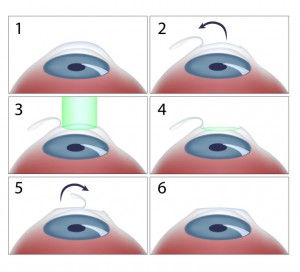 laser oftalmologie